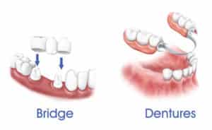 Dental Bridge vs Dentures Hilton Head Island