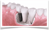 Dental Implants Bluffton SC