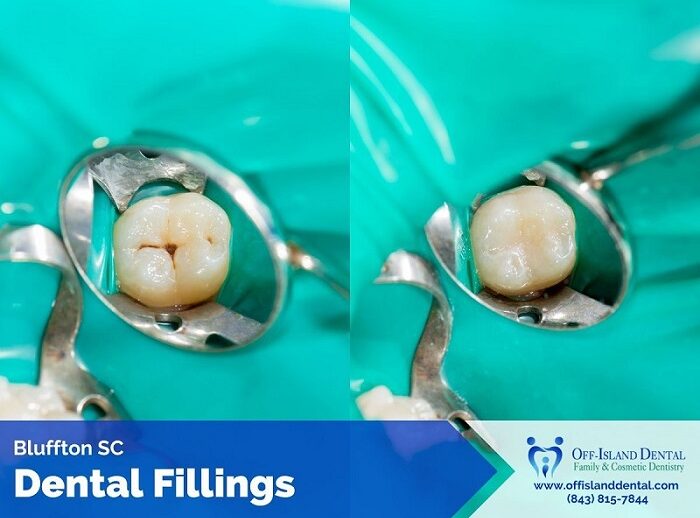 dental fillings Bluffton SC
