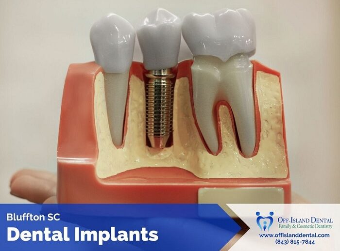 Dental Implants in Bluffton