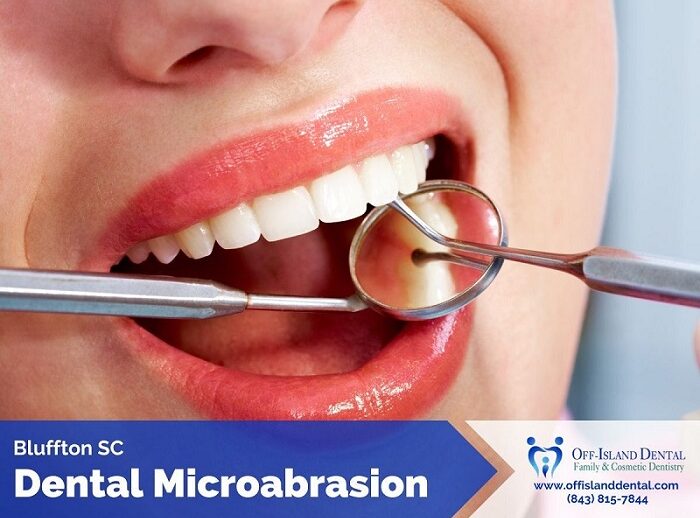 Dental Microabrasion Bluffton SC
