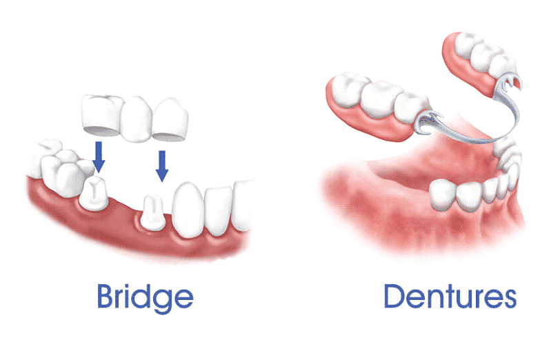 Bridge Vs. Dentures